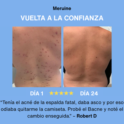 Bacne - Elimina tu acné de la espalda