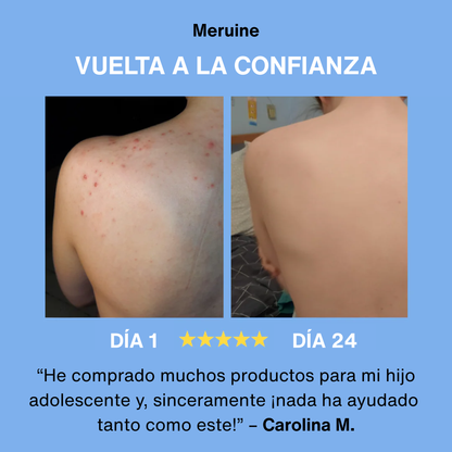 Bacne - Elimina tu acné de la espalda