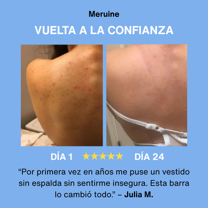 Bacne - Elimina tu acné de la espalda